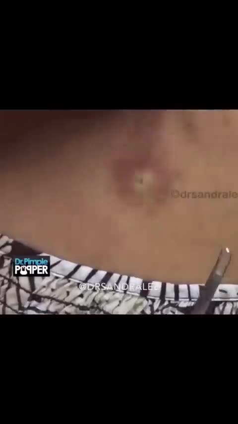 The gift that kept on giving! A Non-Stop Pop by Dr Pimple Popper ✌️❤️💥