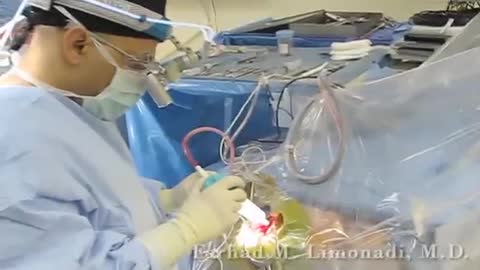 Awake Brain Surgery (Removal of brain tumor while patient is awake)