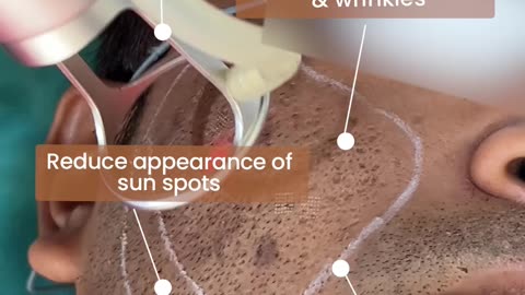 Acne Scar Treatment | La Midas Aesthetics