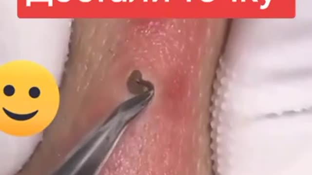 Acne Treatment 2022#Technicalexpertguru