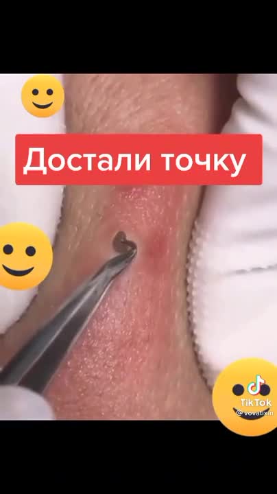 Acne Treatment 2022#Technicalexpertguru