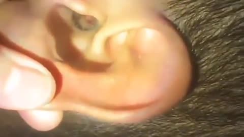 Blackheads Removal in the Ear.