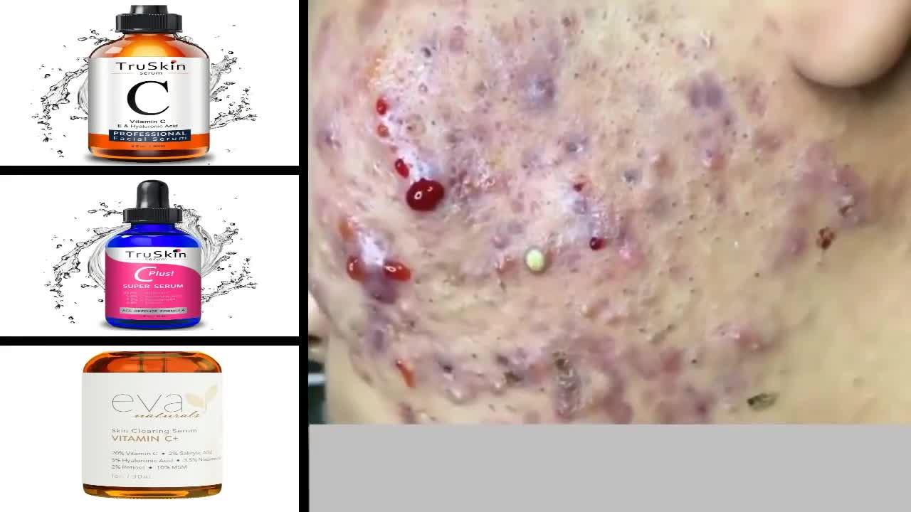 Blackheads Removal & Pimple Popping