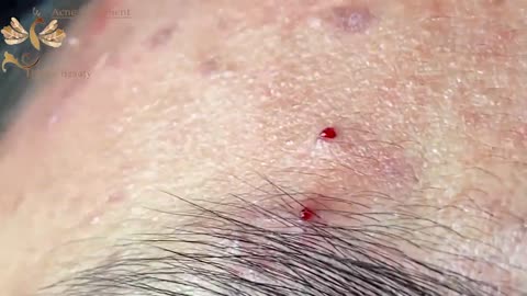 #110 | Acne Treatment Huong beauty | Part 1