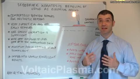 seborrheic keratosis removal, beautyteck