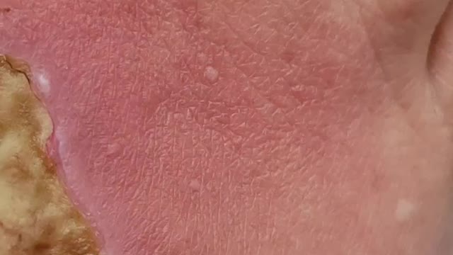 Victor foot wound