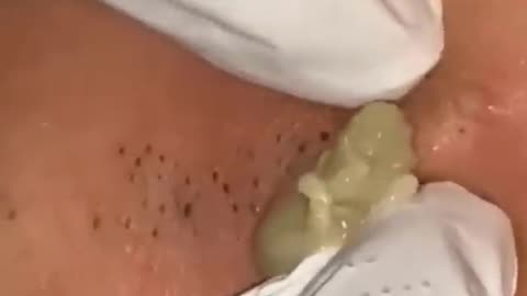 pimple popping