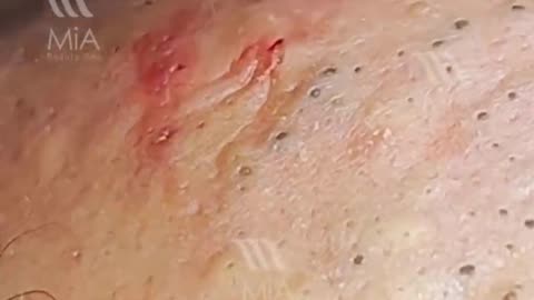 pimple popping