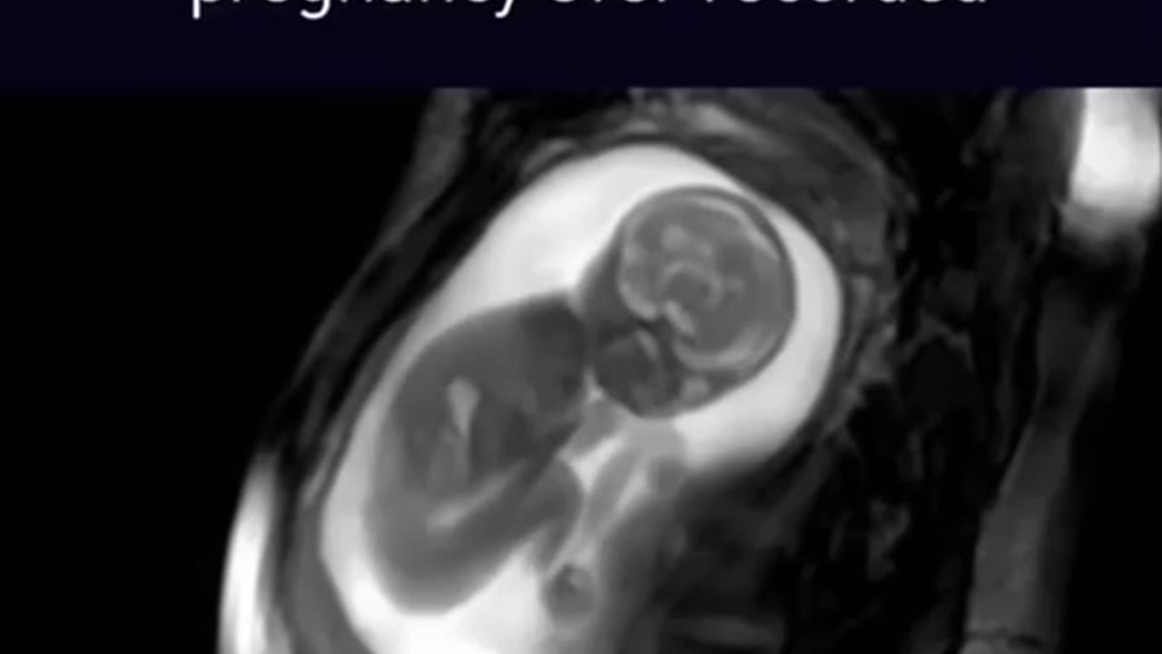 Robert F Kennedy Jr supports a woman's right to end a baby's life at full term.