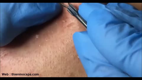 Compilation of the most terrifying acne squeezing moments. Squeeze acne.