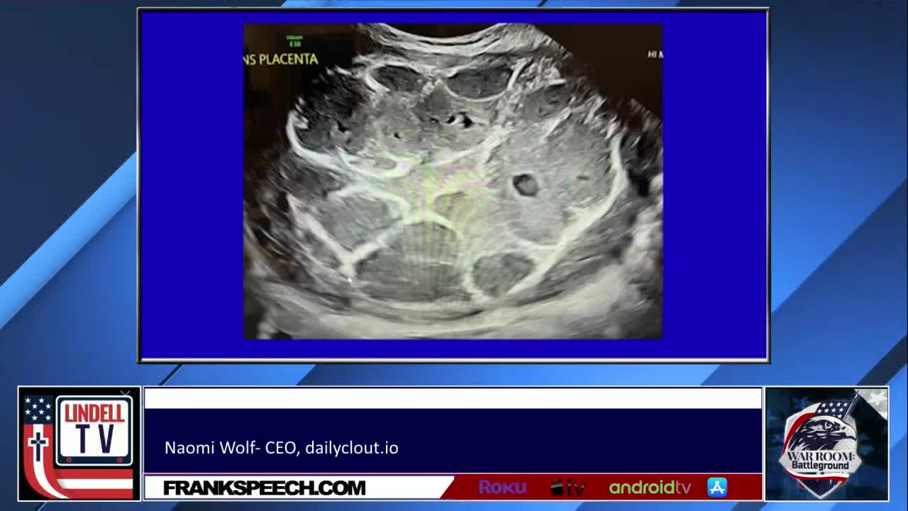 COVID-19 VAXX AND PREGNANCY