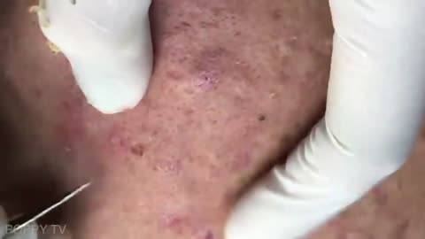 Deep Blackheads Removal