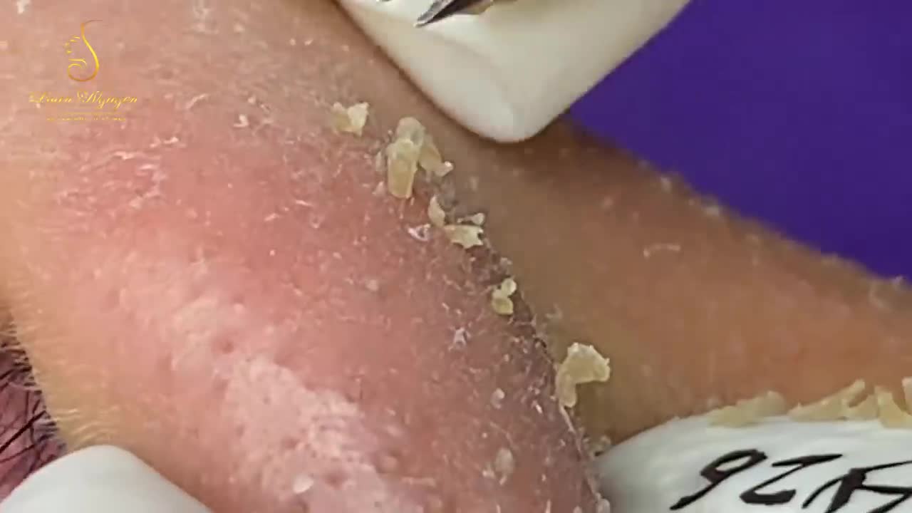 Blackhead removal extraction