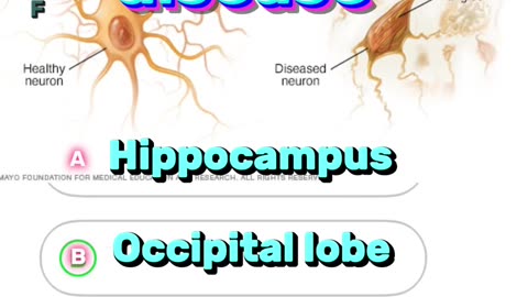 Alzheimer’s disease question answers MCQs : neurological disorder,#disease #mcqs #3dmedico 🧠👩🏻‍🦼