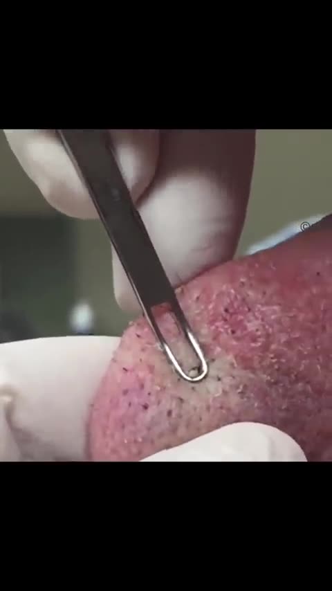 Blackheads or Sebaceous Filaments