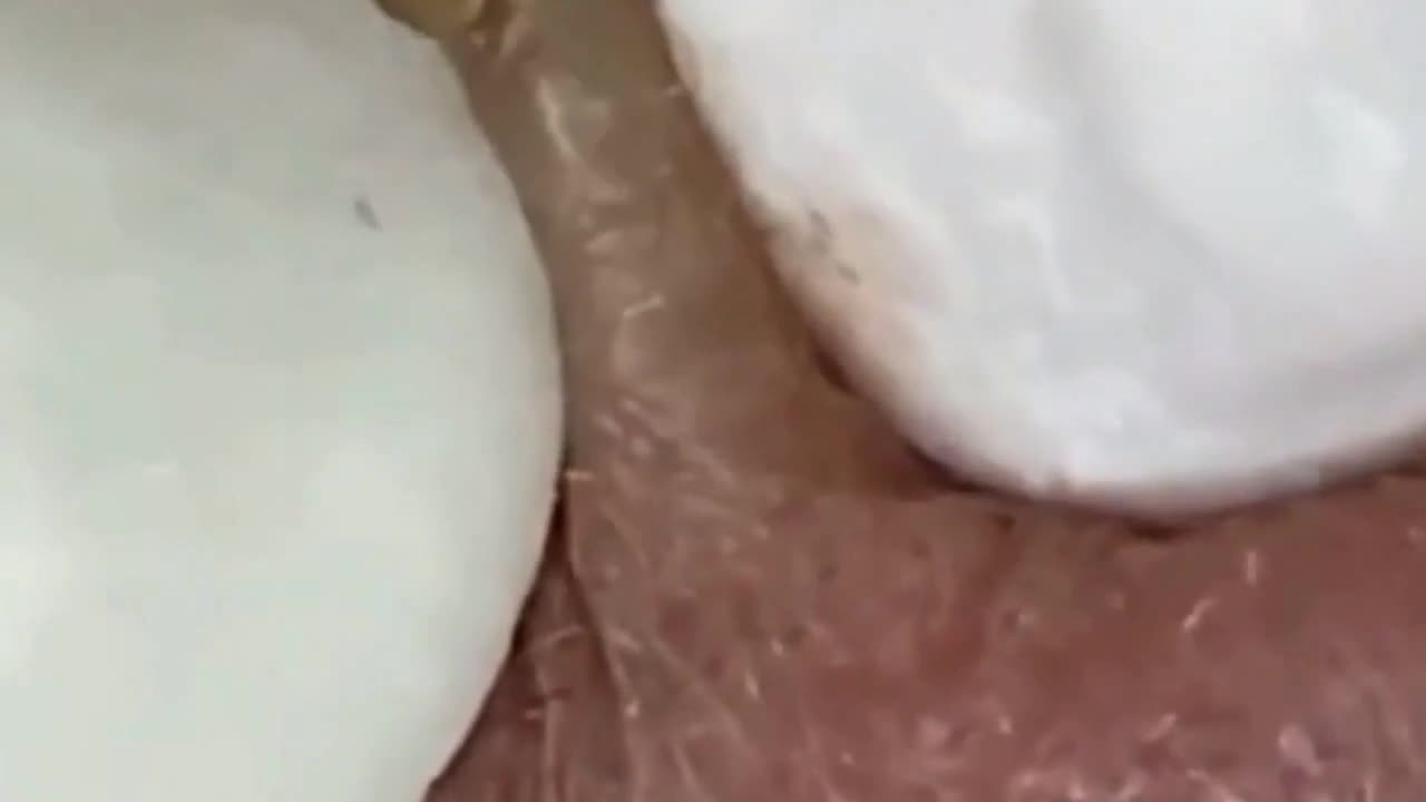 Dr Pimple Popper Removes a Juicy Blackhead