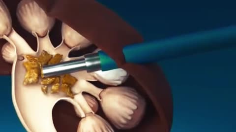 Kidney Stone Removal😨🩺 | How Doctors Get Rid of Painful Stones #kidneyStone #surgery #medical