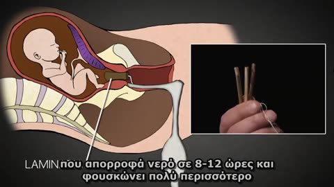 Διαδικασία έκτρωσης 1ου, 2ου, και 3ου τριμήνου