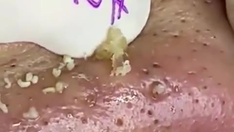 Huge blackhead extraction