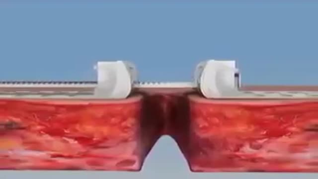 خياطة الجروح من غير ابرة وخيط