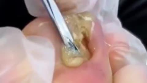 White liquid gushing out from toenail ingrown removal