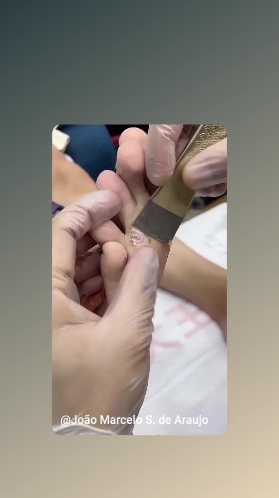 Removing insects with a suitable instrument