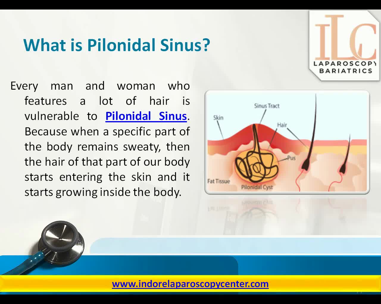 Laser Pilonidal Sinus Specialist in Indore Dr. Achal Agrawal