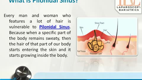 Laser Pilonidal Sinus Specialist in Indore Dr. Achal Agrawal