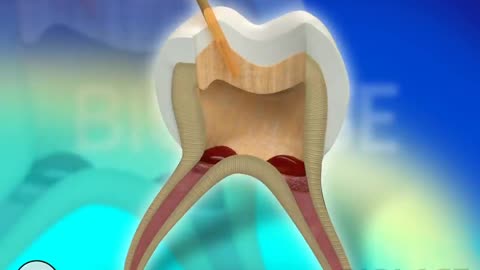 Tooth Restoration