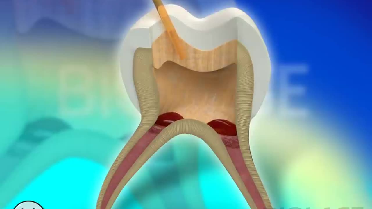 Tooth Restoration