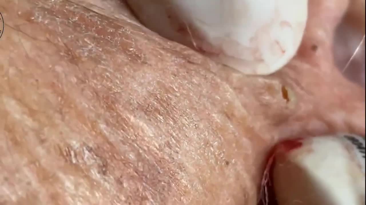 Blackheads & Milia, Big cystic acne blackheads extraction whiteheads Removal Pimple Popping.