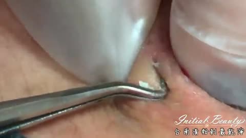 blackheads on back - Taiwan Tainan