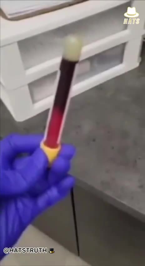 Vaccinated patient's blood clots in 3 minutes instead of 30 minutes