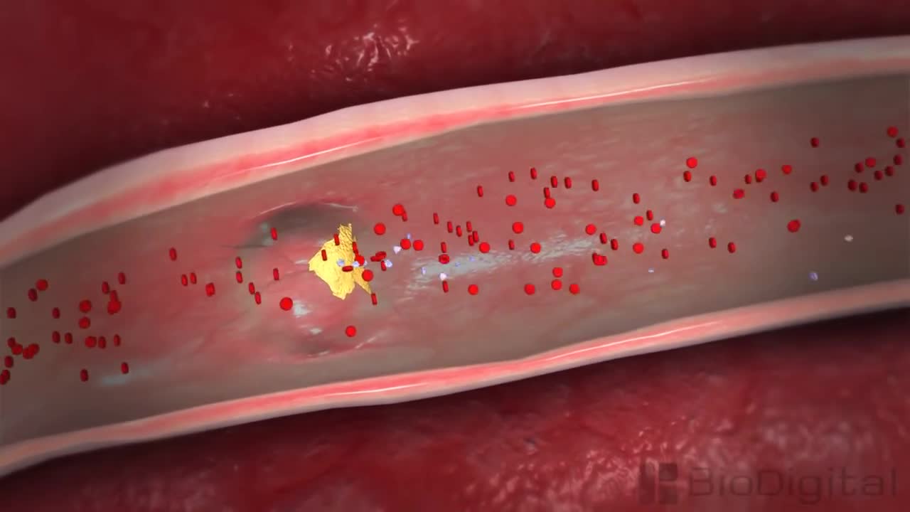 3D medical animation: What is a heart attack?