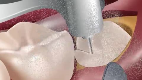 ASMR Help Rango Tenge Tenge, Wisdom Teeth & Cavity Treatment