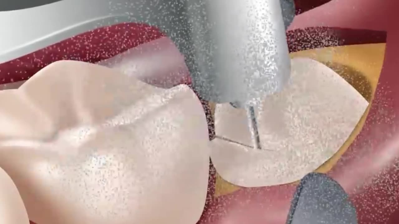 ASMR Help Rango Tenge Tenge, Wisdom Teeth & Cavity Treatment