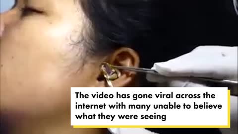 ‘Surgeon’ struggles to remove live snake from woman’s ear in viral video