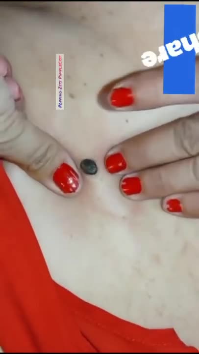 Giant Blackhead Extraction