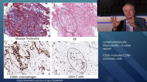 Chris Martenson: JAMA: mRNA vaccines elevate myocarditis risk by 133x