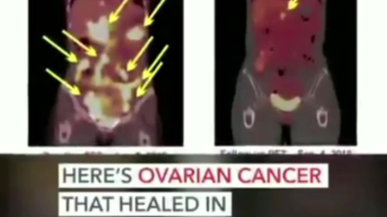 THIS CURE FOR CANCER WAS DISCOVERED 42 YEARS AGO BUT AS BEEN SUPPRESSED SEVERAL TIMES...