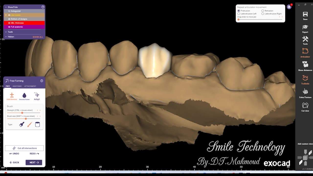 #design #naildesign #dental #dentaldesign #exocadexpert