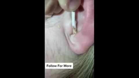 Satisfying Pimples Popping Cyst Removal Acne Blackheads Compilation Videos