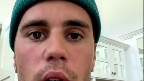 Justin Bieber reveals he has facial paralysisaqaig usn