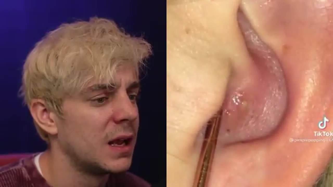 Reacting to the Grossest Pimple Popping Videos