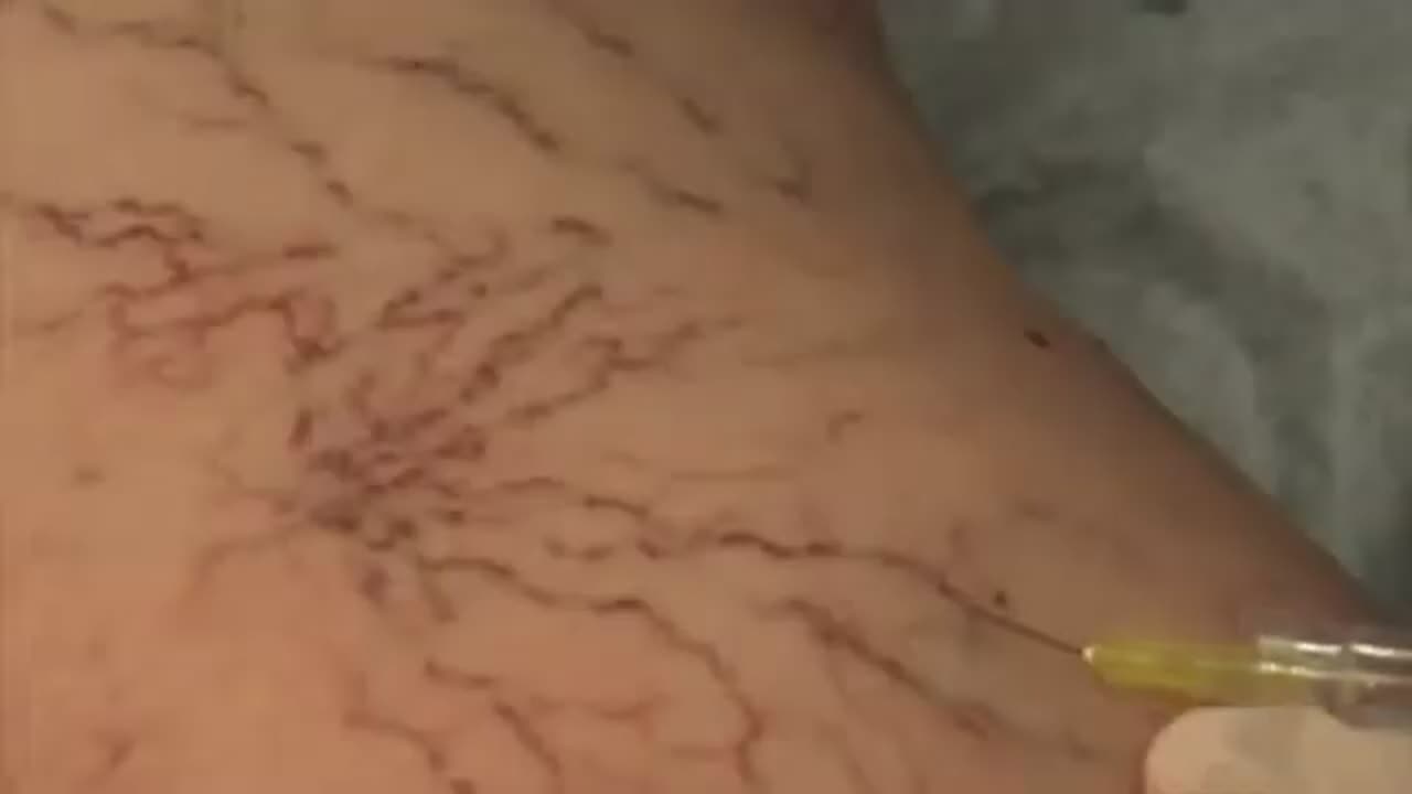 Spider Veins - Sexy Face Aesthetics, Las Vegas