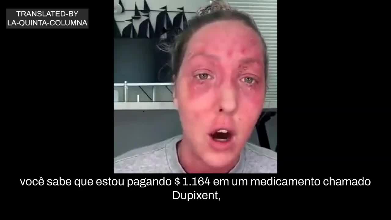 MEU DEUS VEJAM A ALERGIA QUE ESTA MOÇA TEVE ÁS VACIONAS