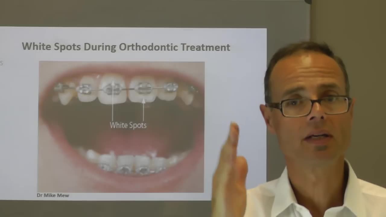 White Spots During Orthodontic Treatment by Dr Mike Mew