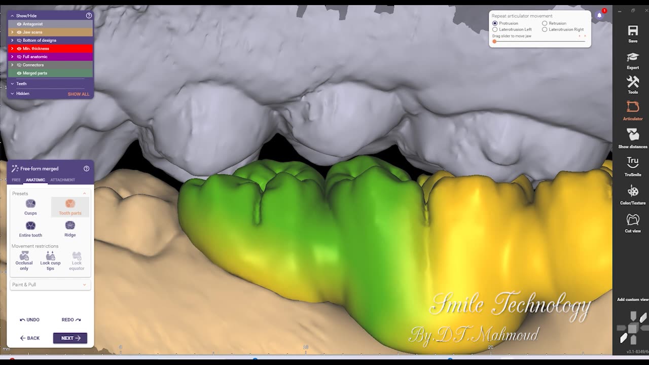 #design #naildesign #dental #dentaldesign #exocadexpert