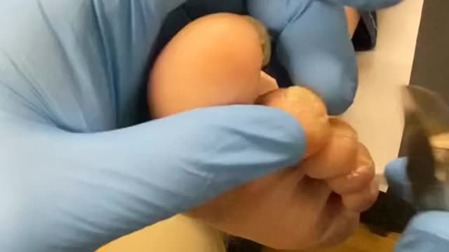 Very long nail trimming by Australian Podiatrist