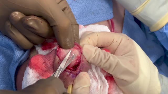 *GRAPHIC* Removal of Silicone Injections from the Male Pubic Region